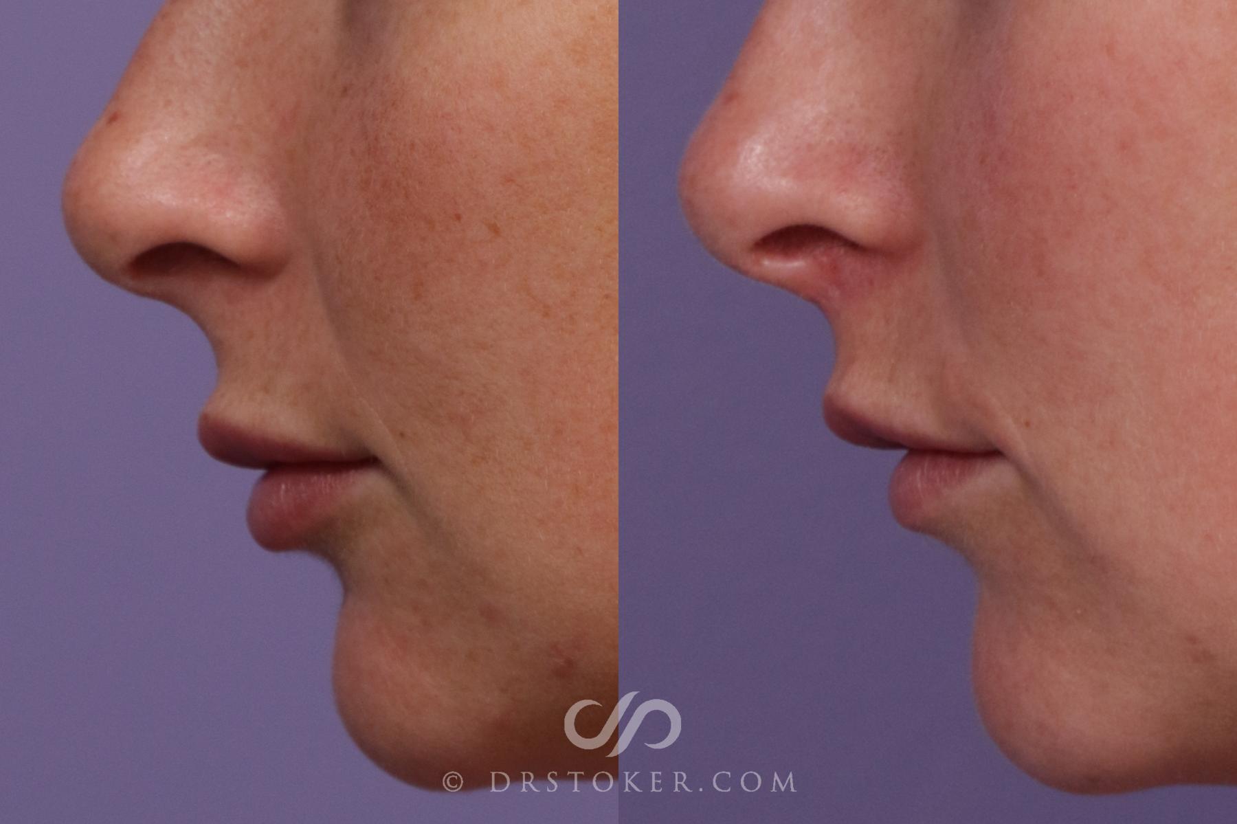 Before & After Lip Lift Case 1803 Left Side View in Los Angeles, CA