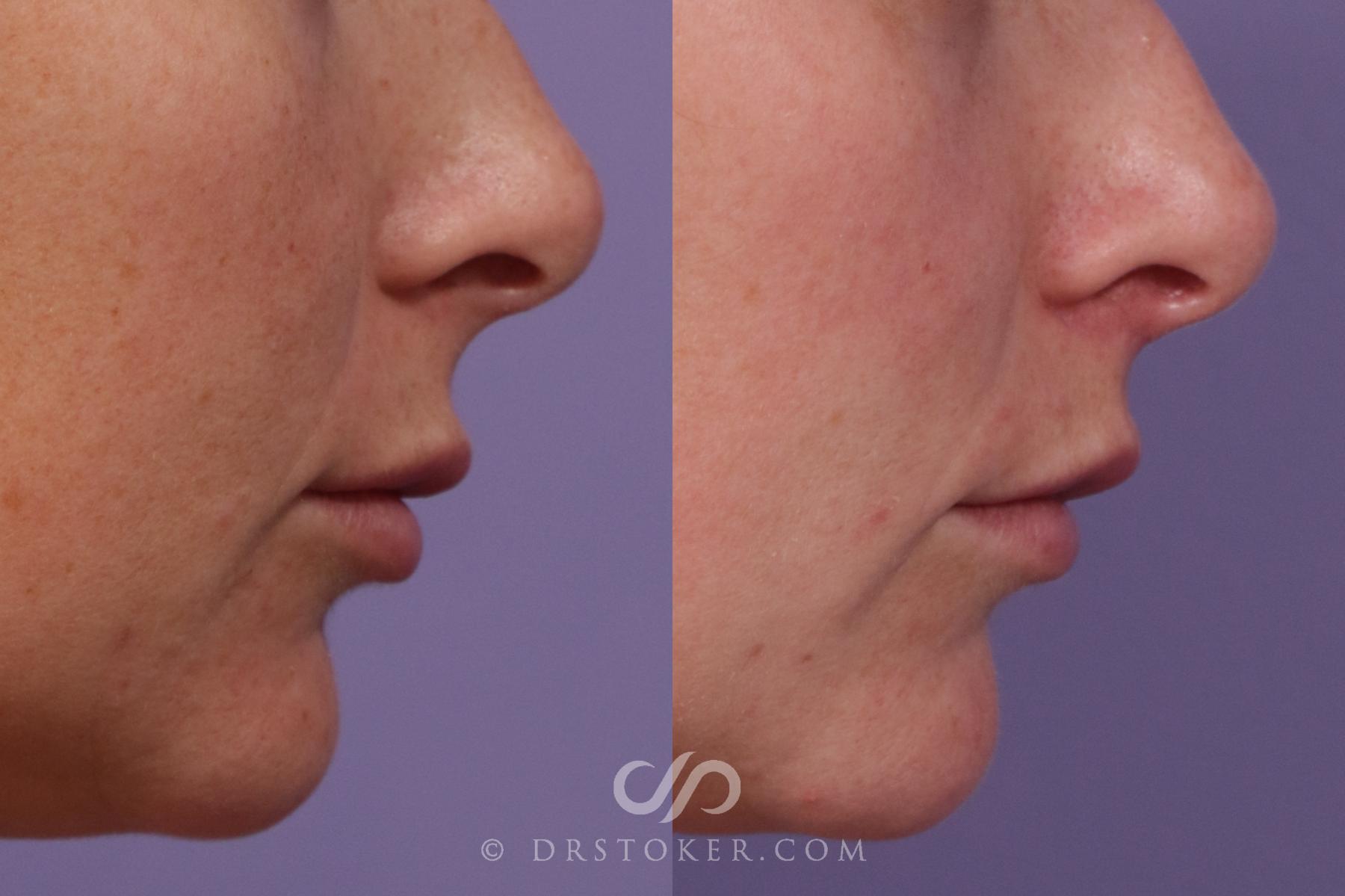 Before & After Lip Lift Case 1804 Right Side View in Los Angeles, CA
