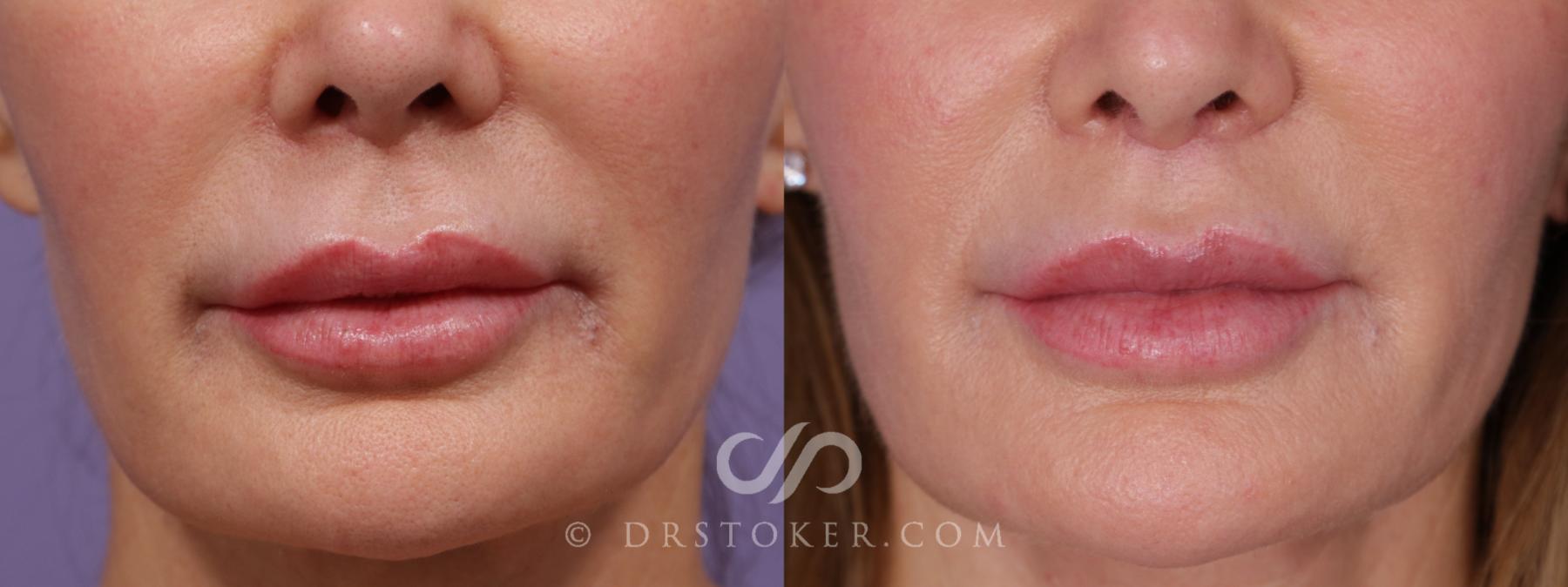 Before & After Lip Lift Case 1805 Front View in Los Angeles, CA