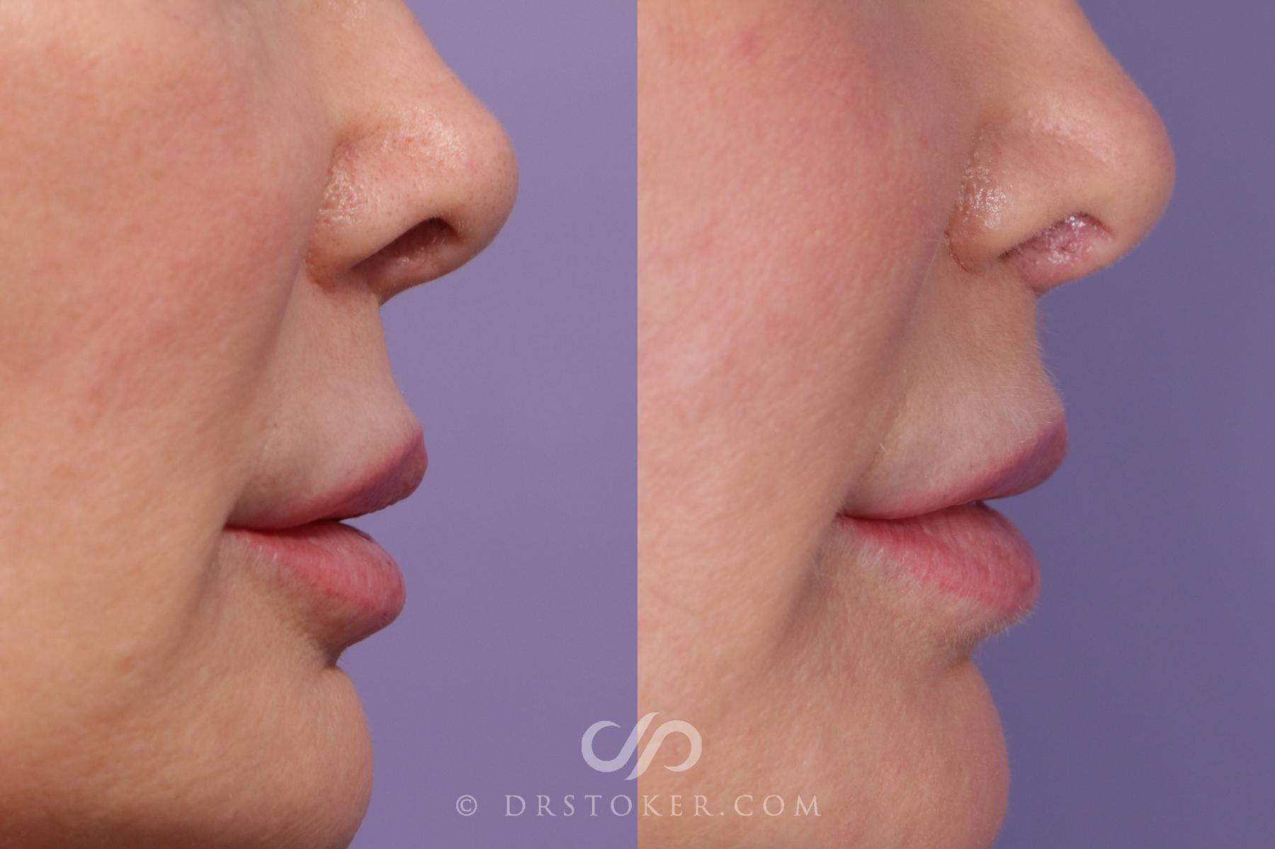 Before & After Lip Lift Case 1806 Right Side View in Los Angeles, CA