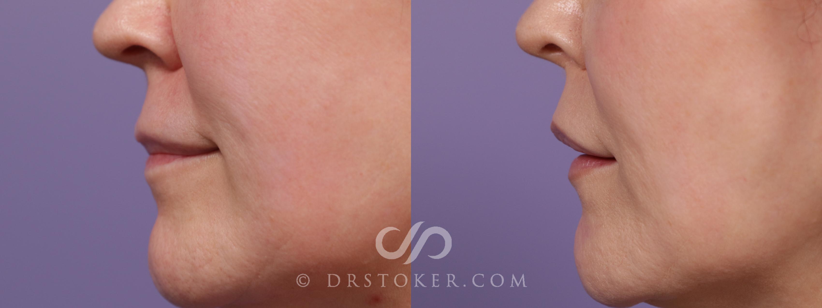 Before & After Lip Lift Case 1951 Left Side View in Marina del Rey, CA