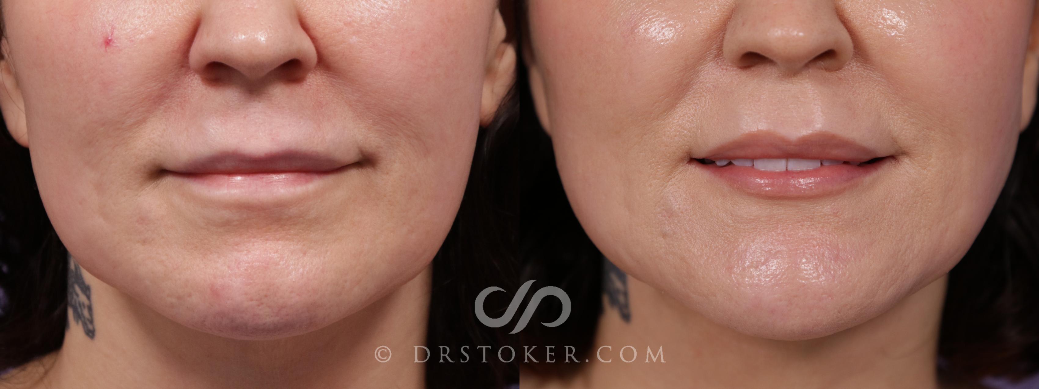 Before & After Lip Lift Case 1996 Front View in Marina del Rey, CA