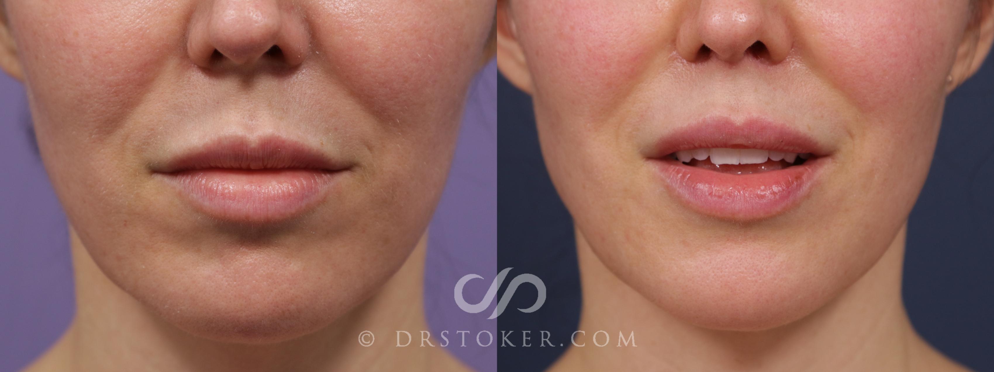 Before & After Lip Lift Case 1997 Front View in Marina del Rey, CA