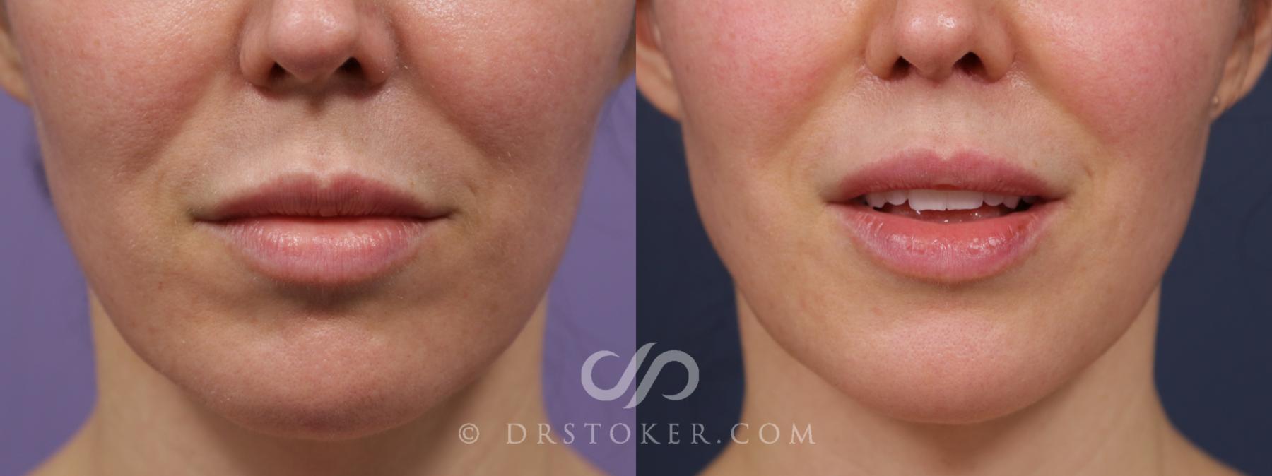 Before & After Lip Lift Case 1997 Front View in Los Angeles, CA