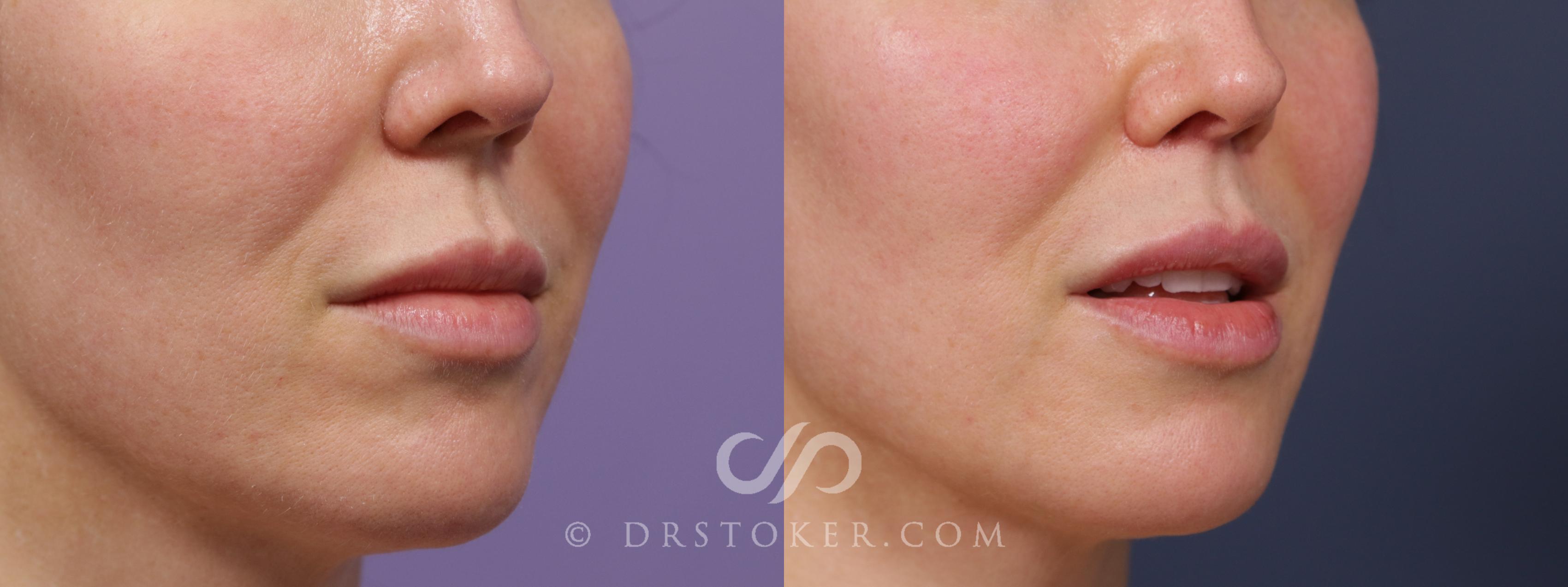 Before & After Lip Lift Case 1998 Right Oblique View in Los Angeles, CA