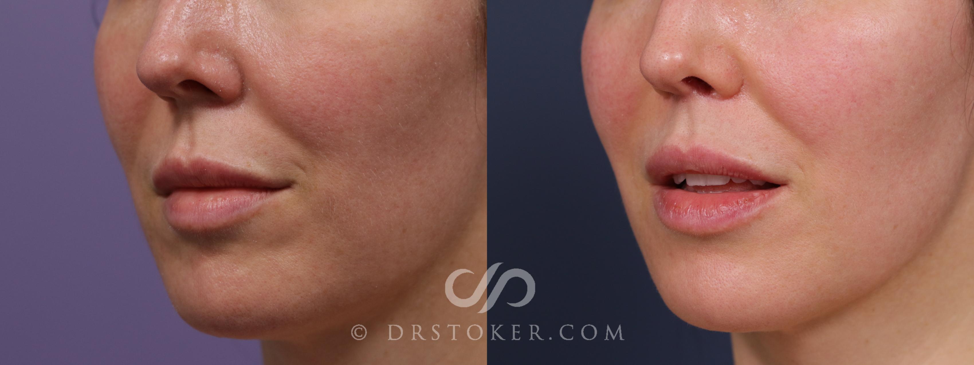 Before & After Lip Lift Case 1999 Left Oblique View in Los Angeles, CA