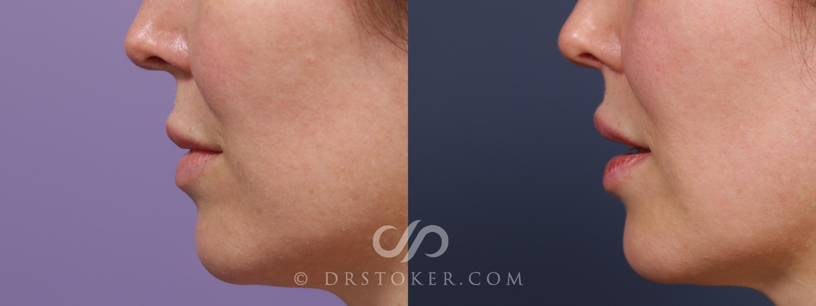 Before & After Lip Lift Case 2001 Left Side View in Marina del Rey, CA