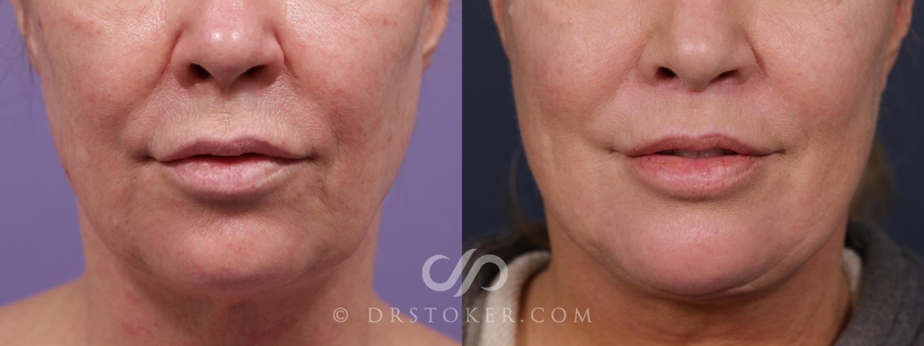 Before & After Lip Lift Case 2002 Front View in Los Angeles, CA