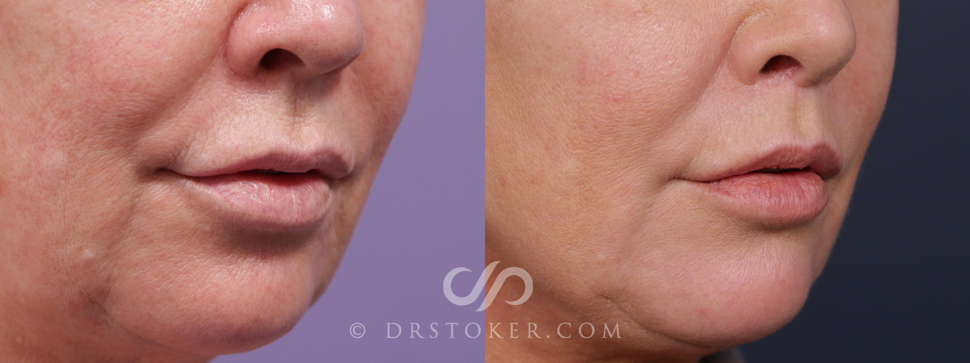 Before & After Lip Lift Case 2003 Right Side View in Los Angeles, CA