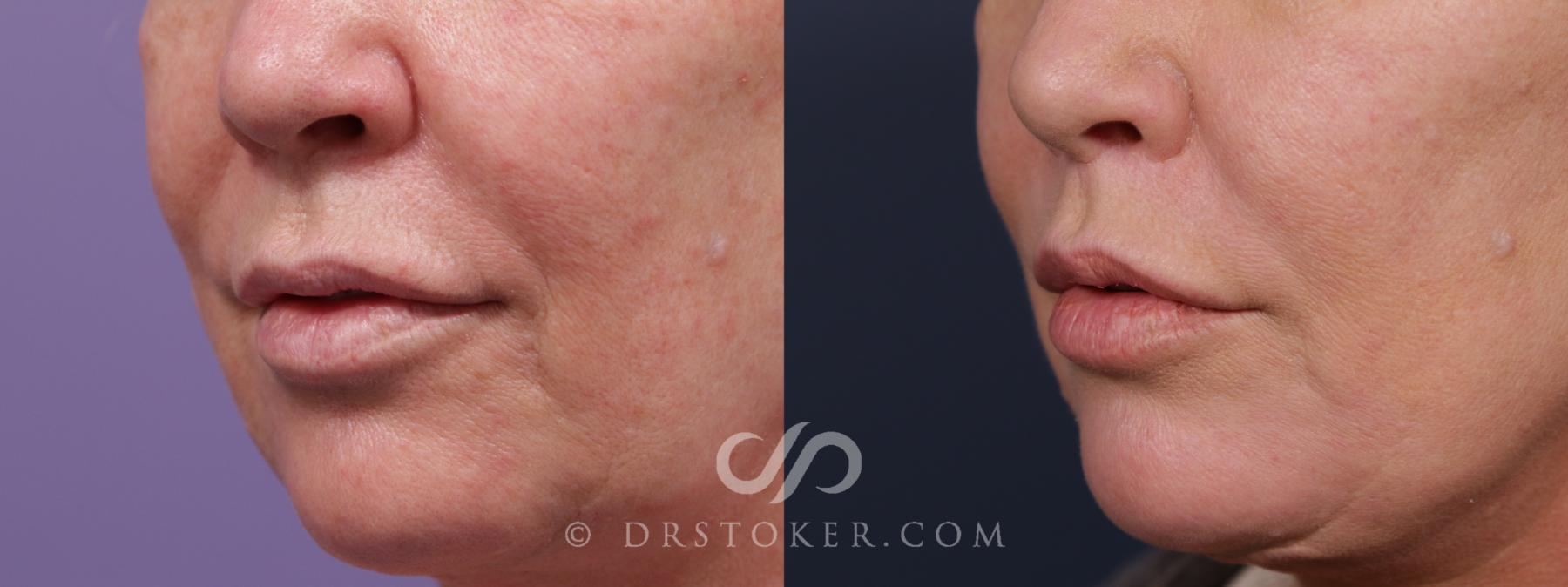 Before & After Lip Lift Case 2004 Left Oblique View in Los Angeles, CA