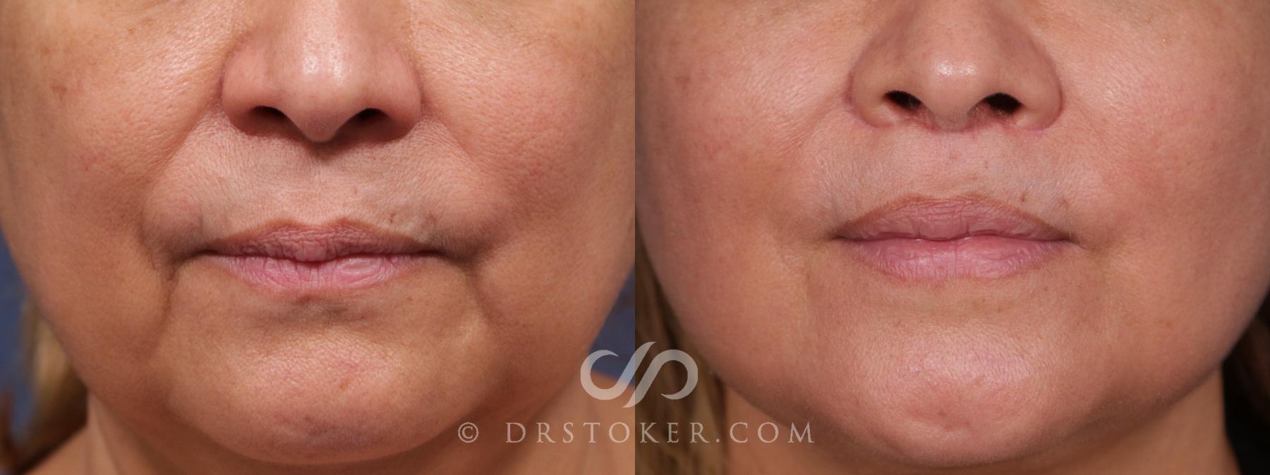 Before & After Lip Lift Case 2032 Front View in Los Angeles, CA