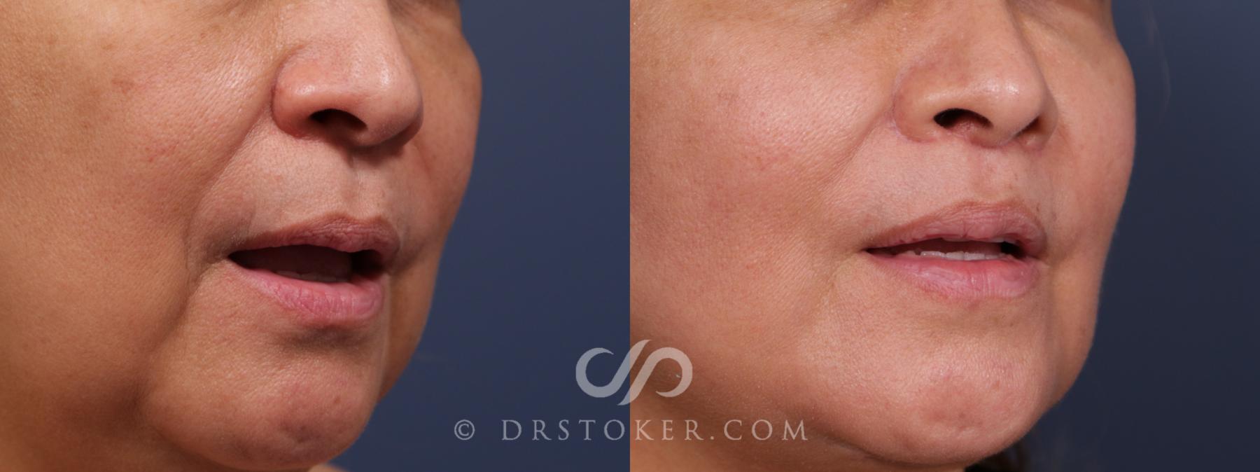 Before & After Lip Lift Case 2032 Right Oblique View in Los Angeles, CA