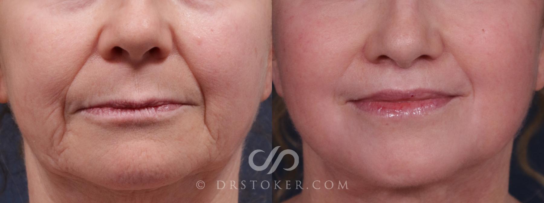 Before & After Lip Lift Case 2159 Front View in Los Angeles, CA