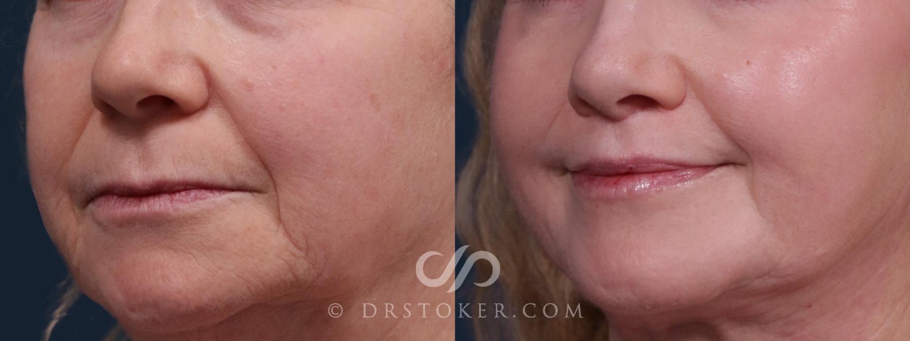 Before & After Lip Lift Case 2159 Left Oblique View in Los Angeles, CA