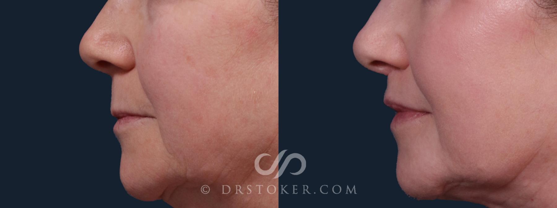 Before & After Lip Lift Case 2159 Left Side View in Los Angeles, CA