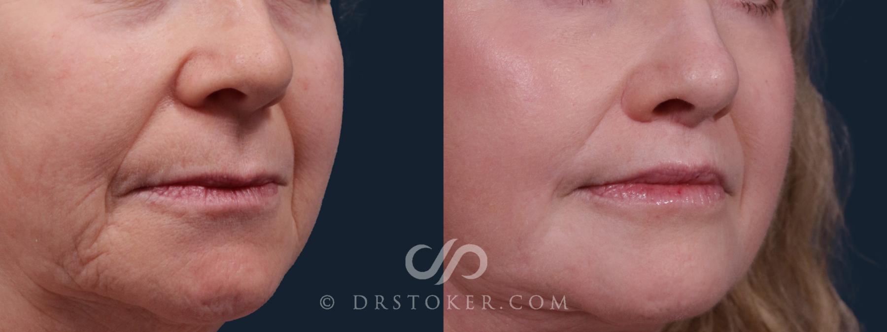 Before & After Lip Lift Case 2159 Right Oblique View in Los Angeles, CA