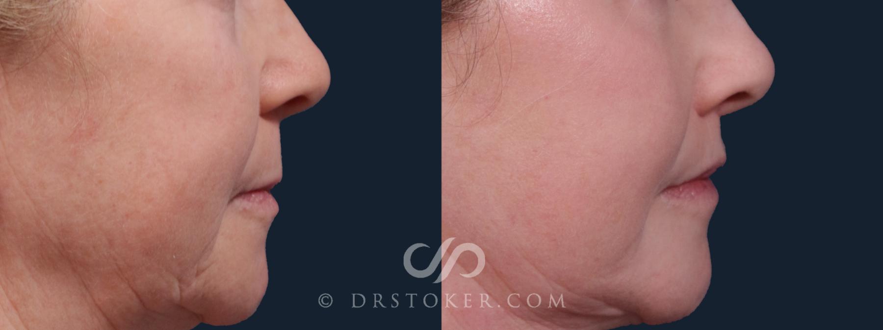 Before & After Lip Lift Case 2159 Right Side View in Los Angeles, CA