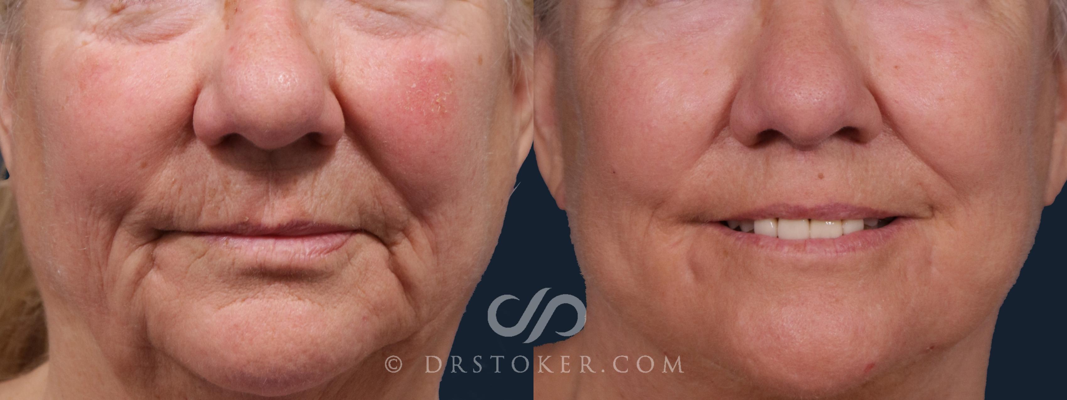 Before & After Lip Lift Case 2220 Front View in Los Angeles, CA