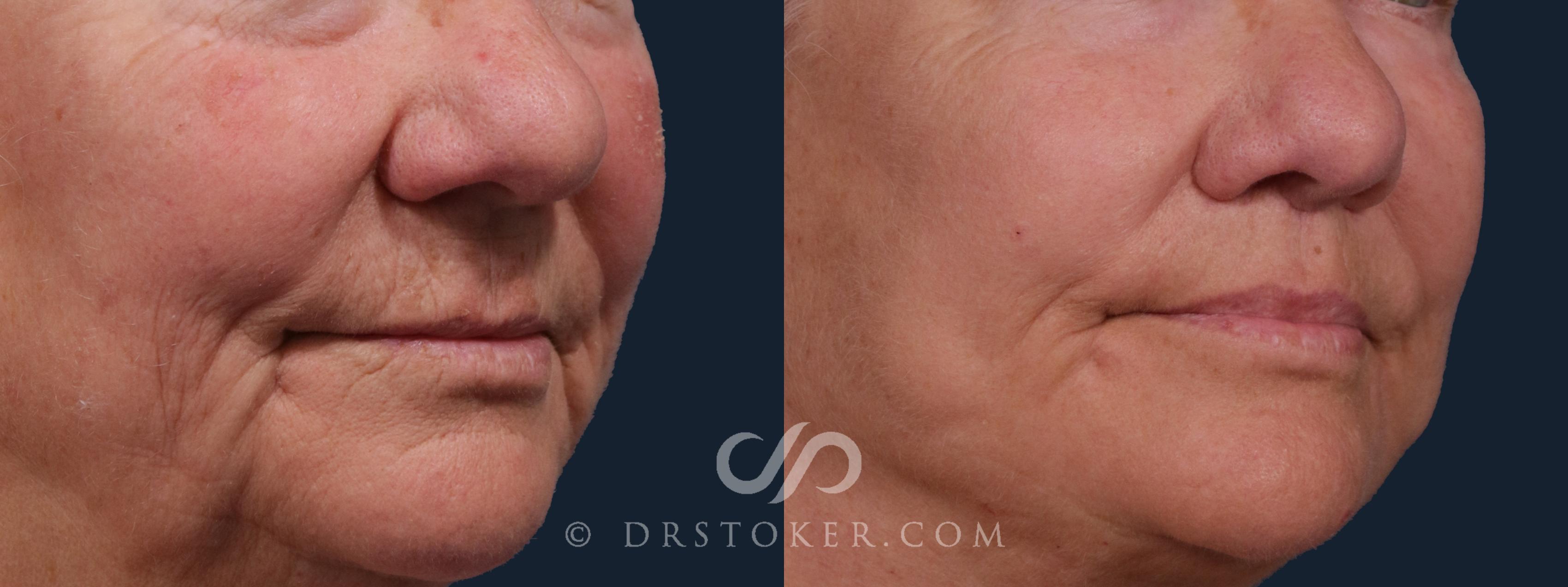 Before & After Lip Lift Case 2220 Right Oblique View in Los Angeles, CA