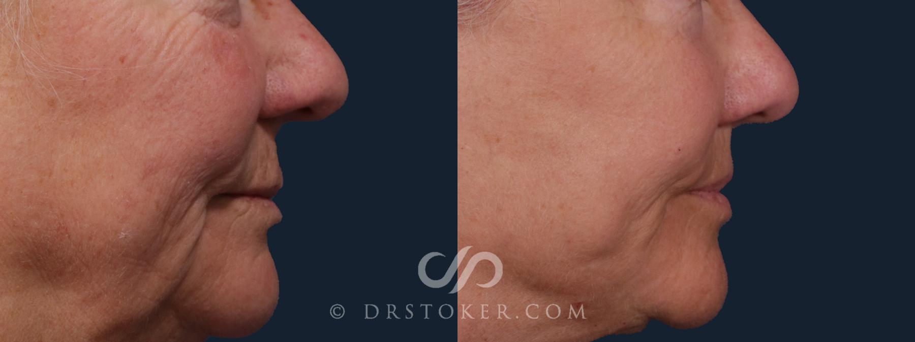 Before & After Lip Lift Case 2220 Right Side View in Los Angeles, CA