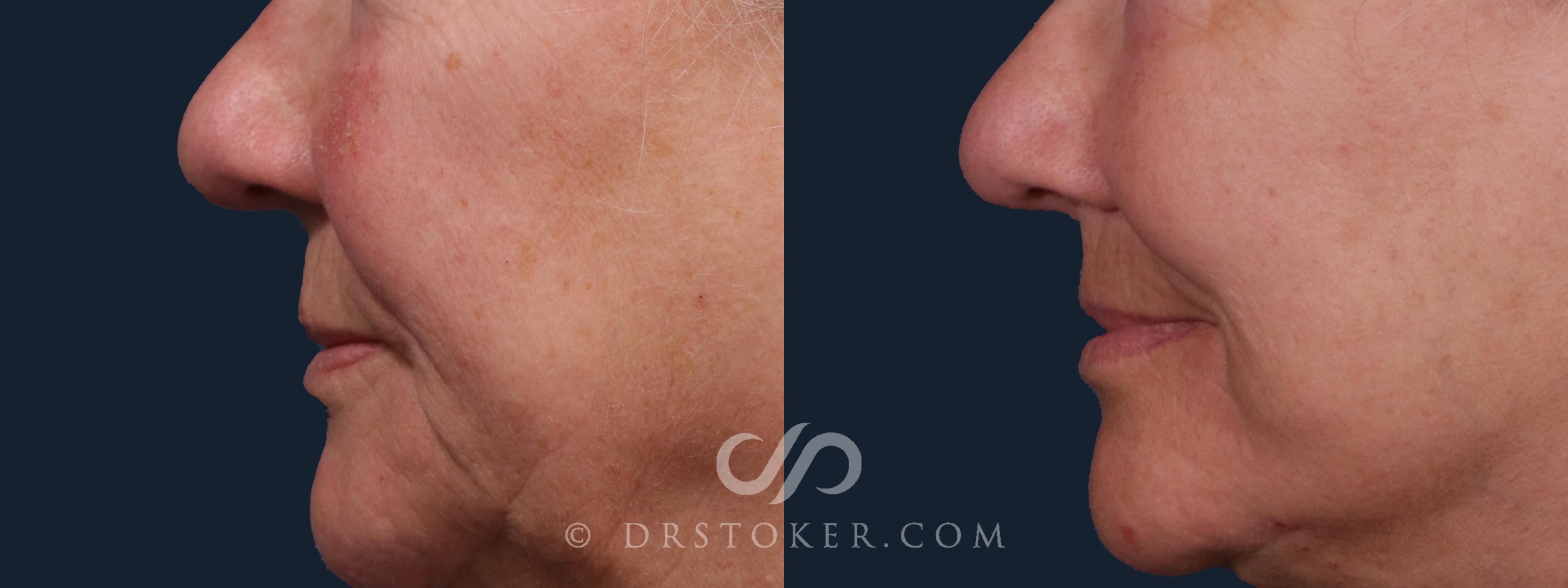 Before & After Lip Lift Case 2221 Left Side View in Los Angeles, CA