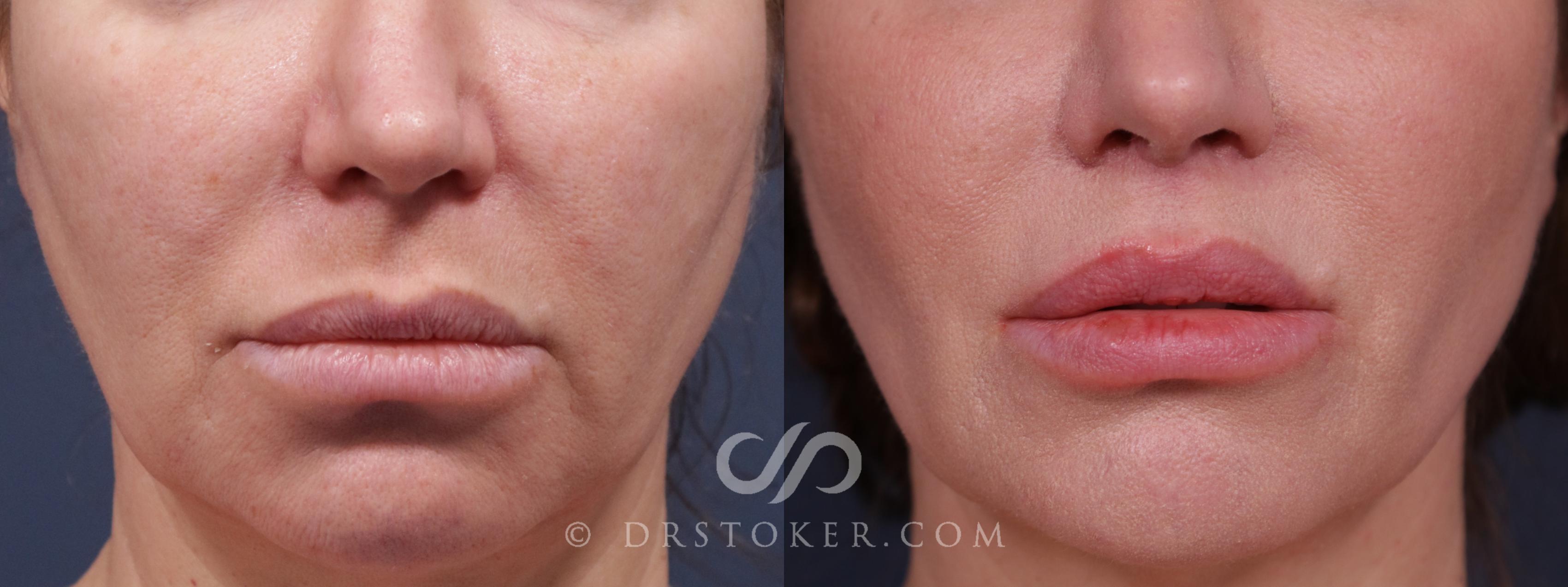 Before & After Lip Lift Case 2223 Front View in Los Angeles, CA