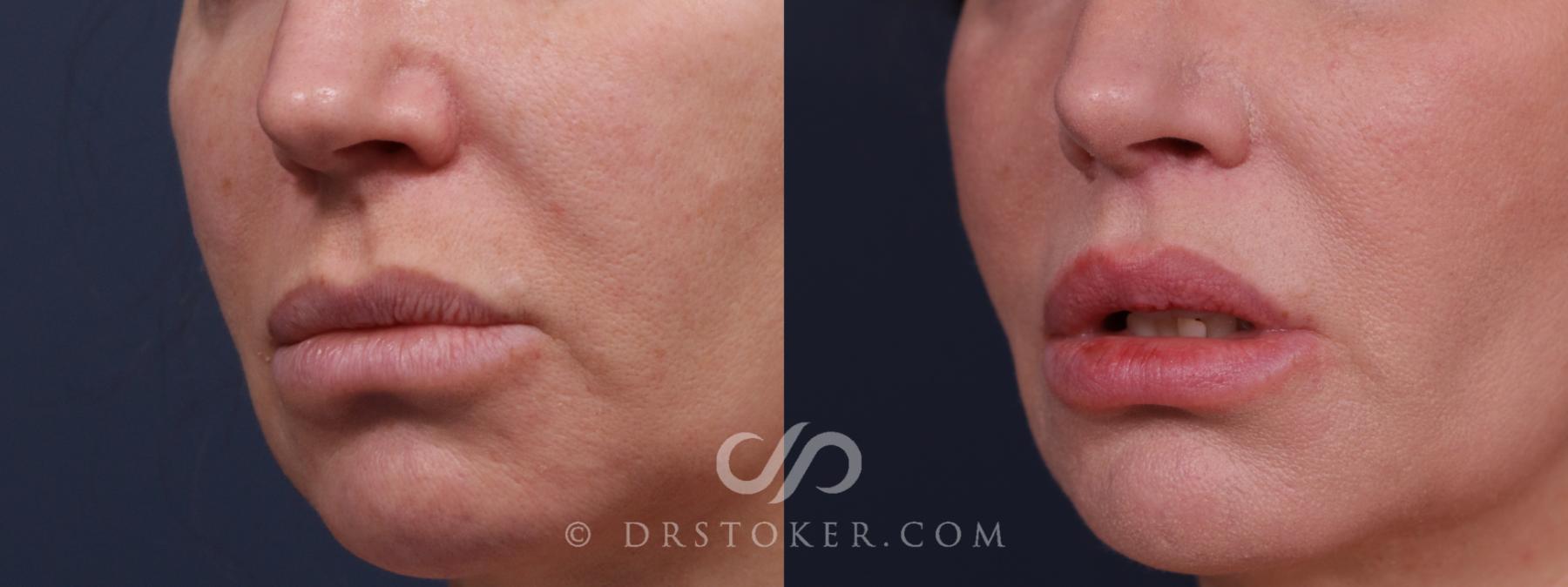 Before & After Lip Lift Case 2223 Left Oblique View in Los Angeles, CA