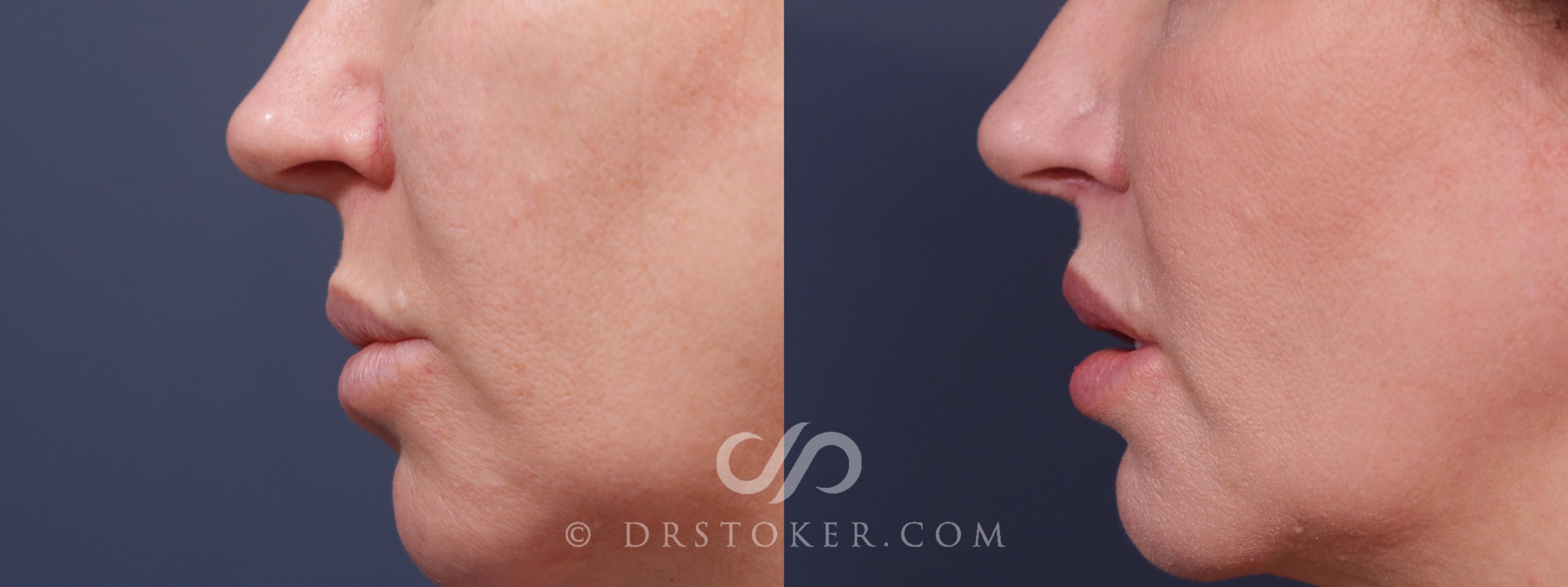 Before & After Lip Lift Case 2223 Left Side View in Los Angeles, CA