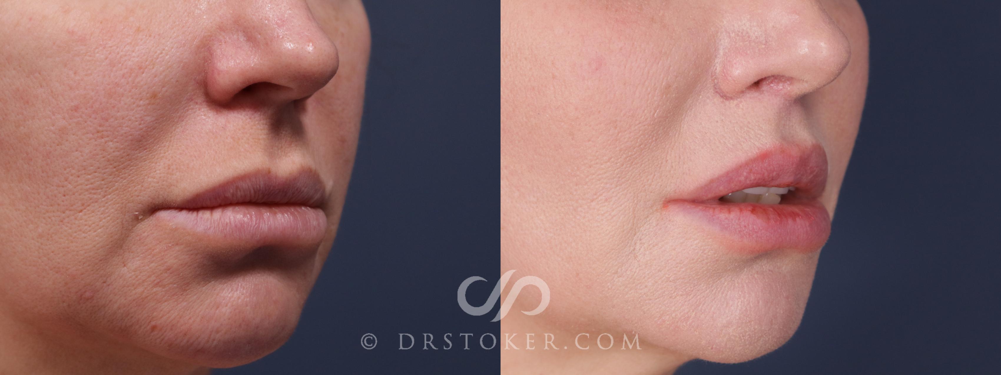 Before & After Lip Lift Case 2223 Right Oblique View in Los Angeles, CA