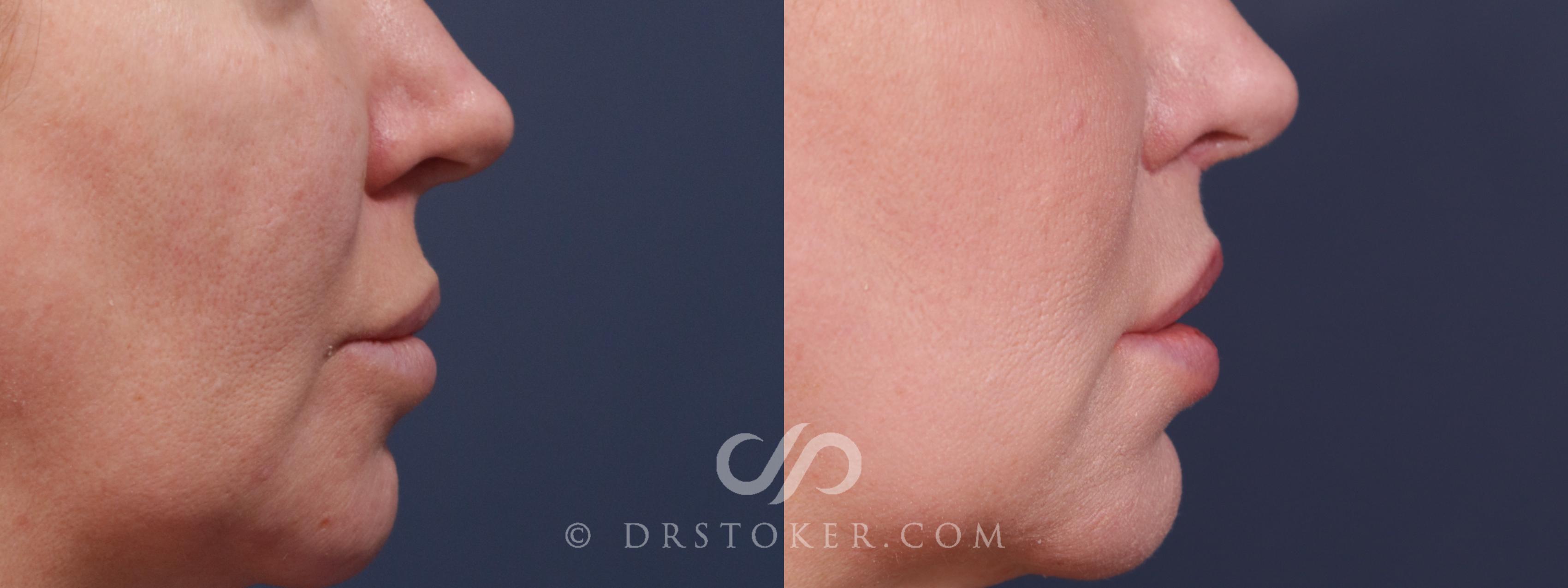 Before & After Lip Lift Case 2223 Right Side View in Los Angeles, CA