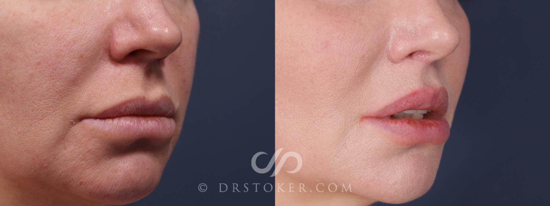 Before & After Lip Lift Case 2224 Right Oblique View in Los Angeles, CA