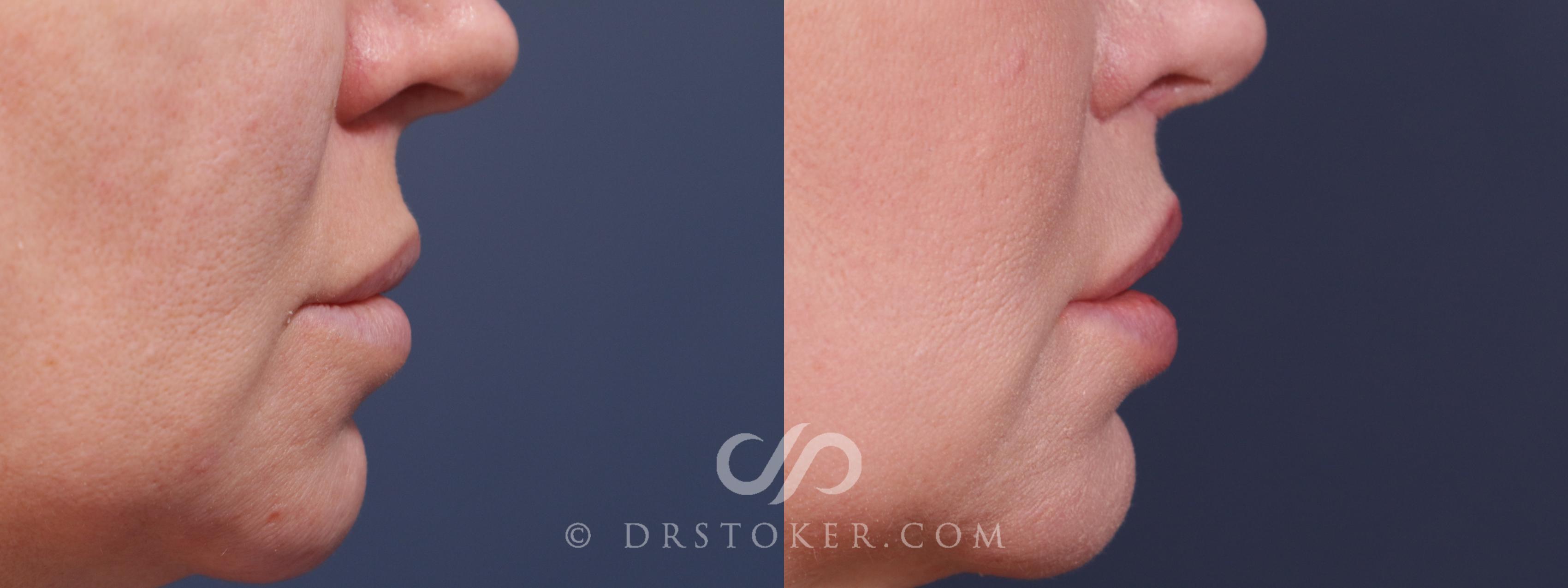 Before & After Lip Lift Case 2225 Right Side View in Los Angeles, CA