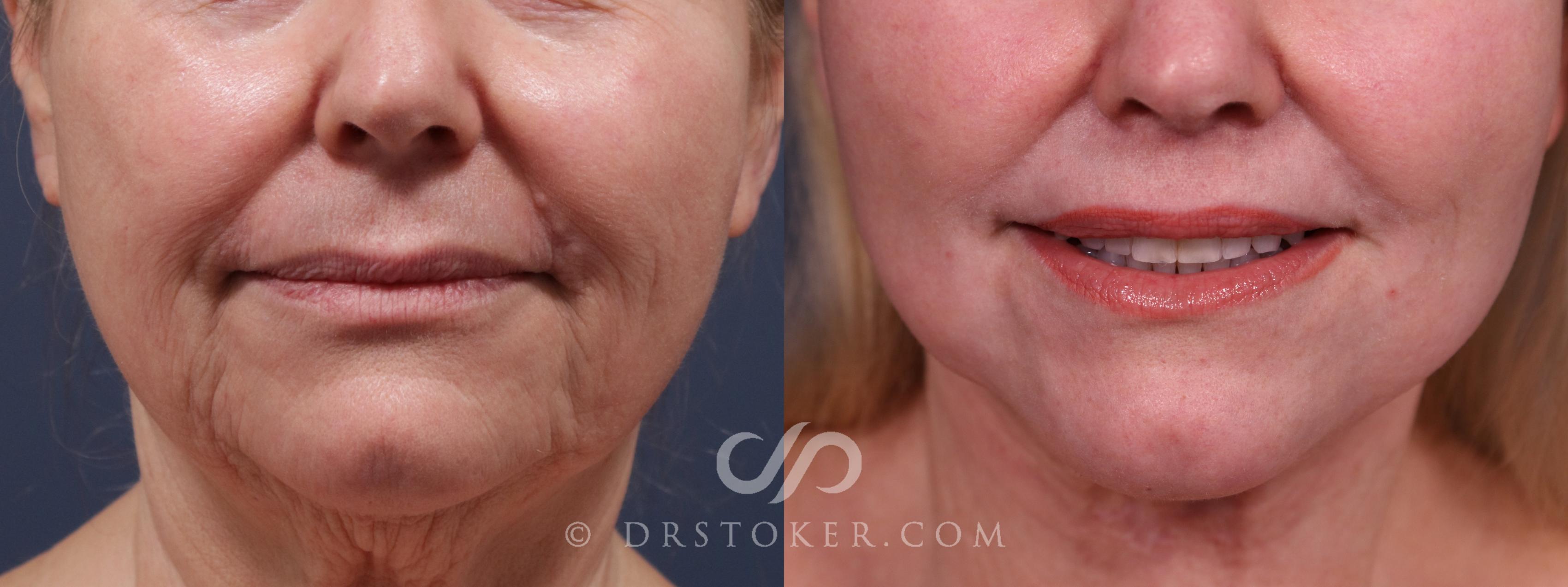 Before & After Lip Lift Case 2305 Front View in Los Angeles, CA