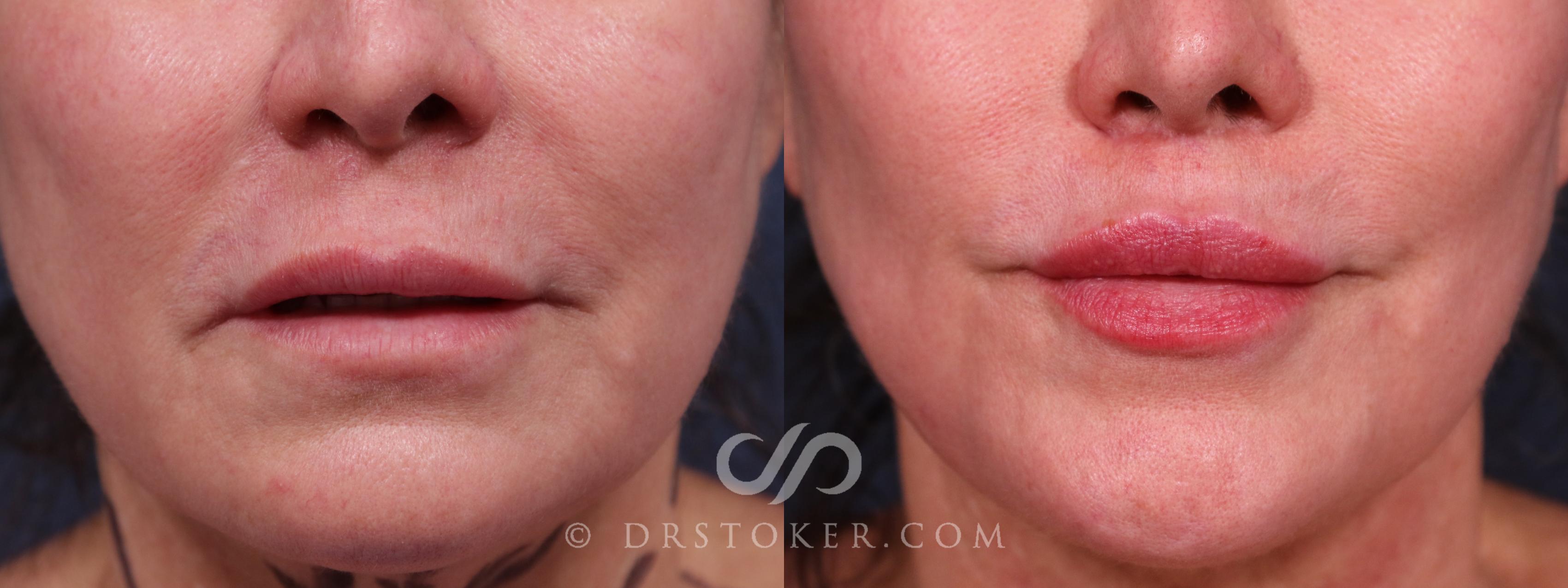 Before & After Lip Lift Case 2318 Front View in Los Angeles, CA