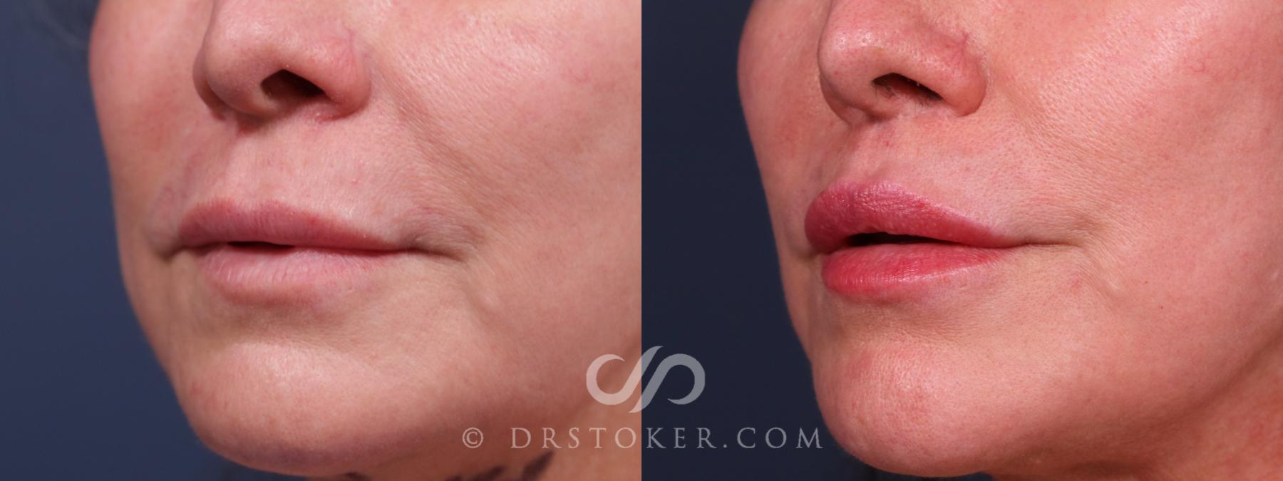 Before & After Lip Lift Case 2318 Left Oblique View in Los Angeles, CA