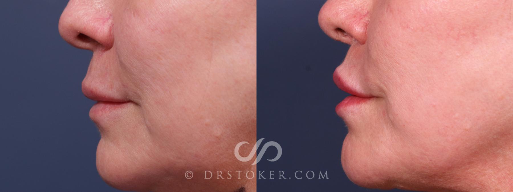 Before & After Lip Lift Case 2318 Left Side View in Los Angeles, CA