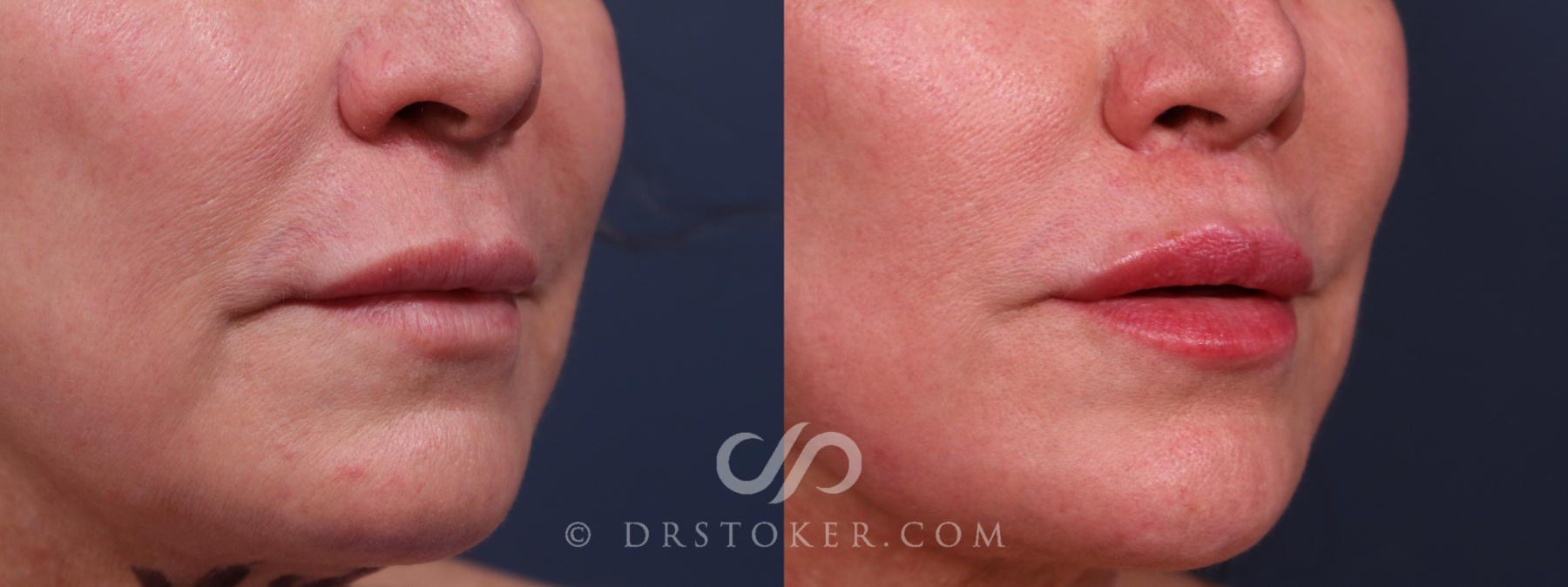 Before & After Lip Lift Case 2318 Right Oblique View in Los Angeles, CA