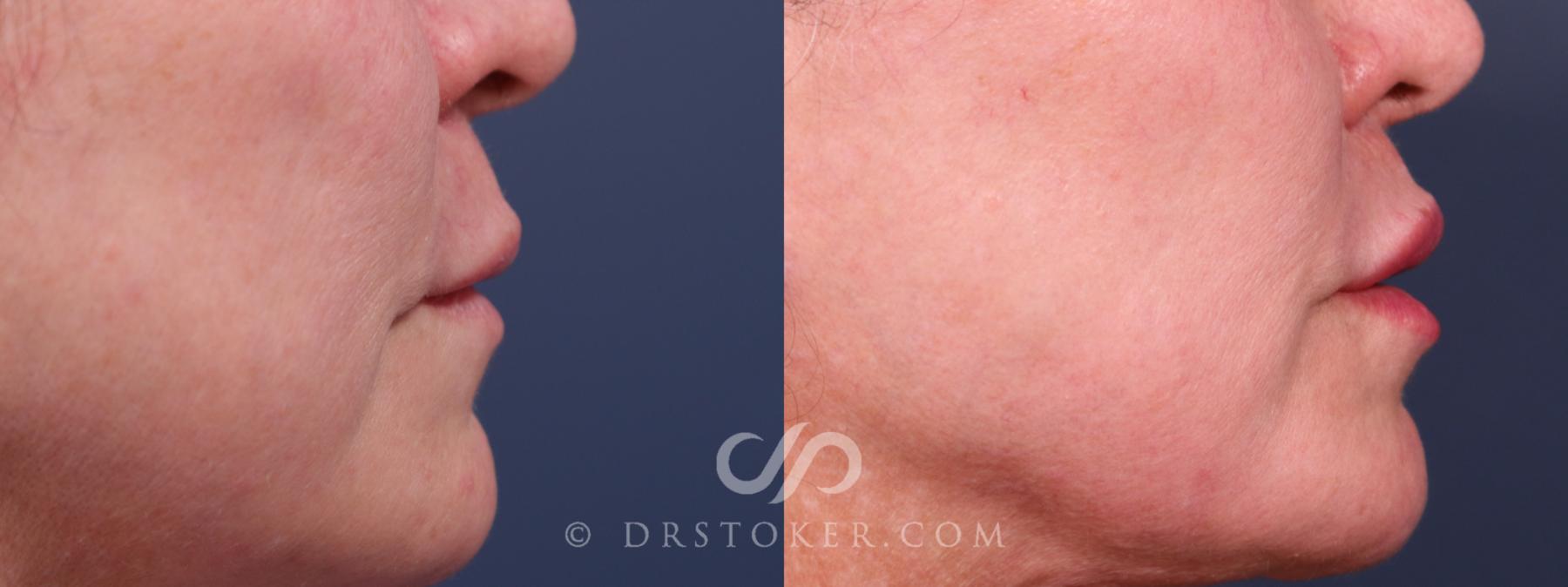 Before & After Lip Lift Case 2318 Right Side View in Los Angeles, CA