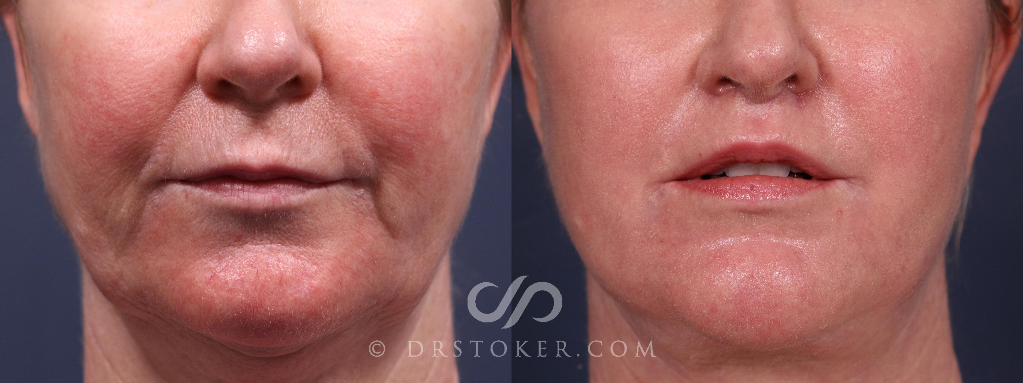 Before & After Lip Lift Case 2342 Front View in Los Angeles, CA