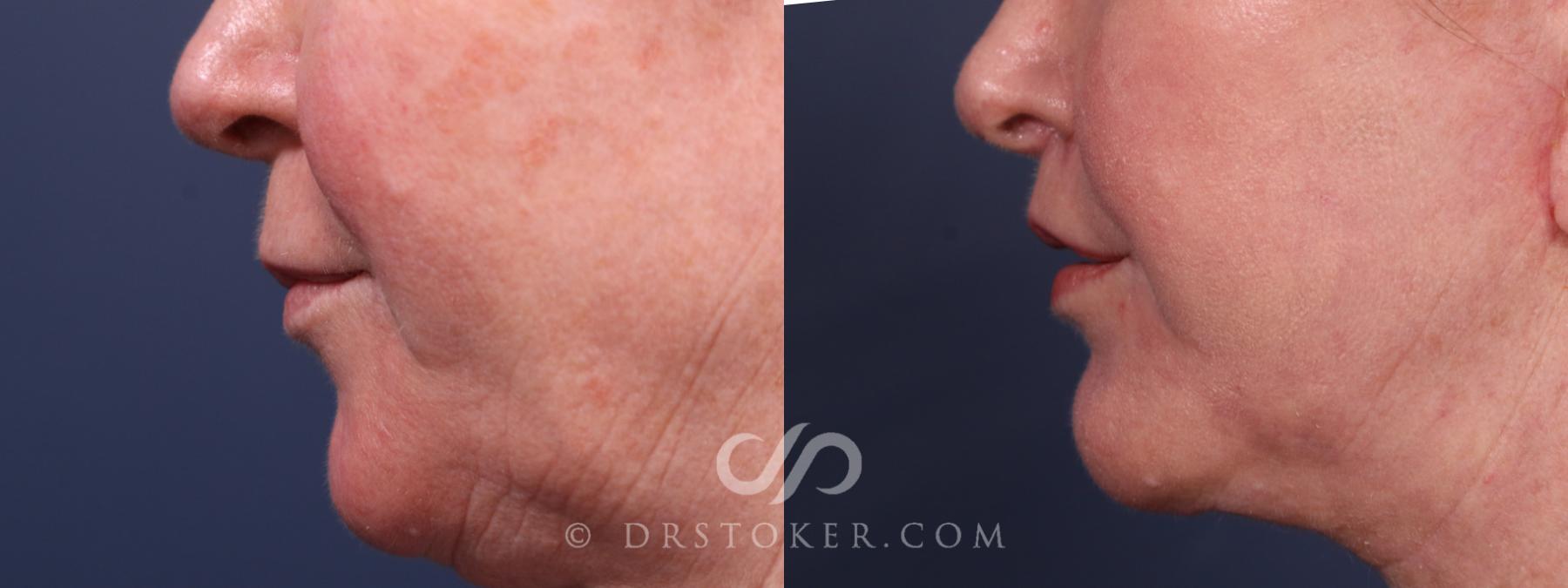 Before & After Lip Lift Case 2342 Left Side View in Los Angeles, CA