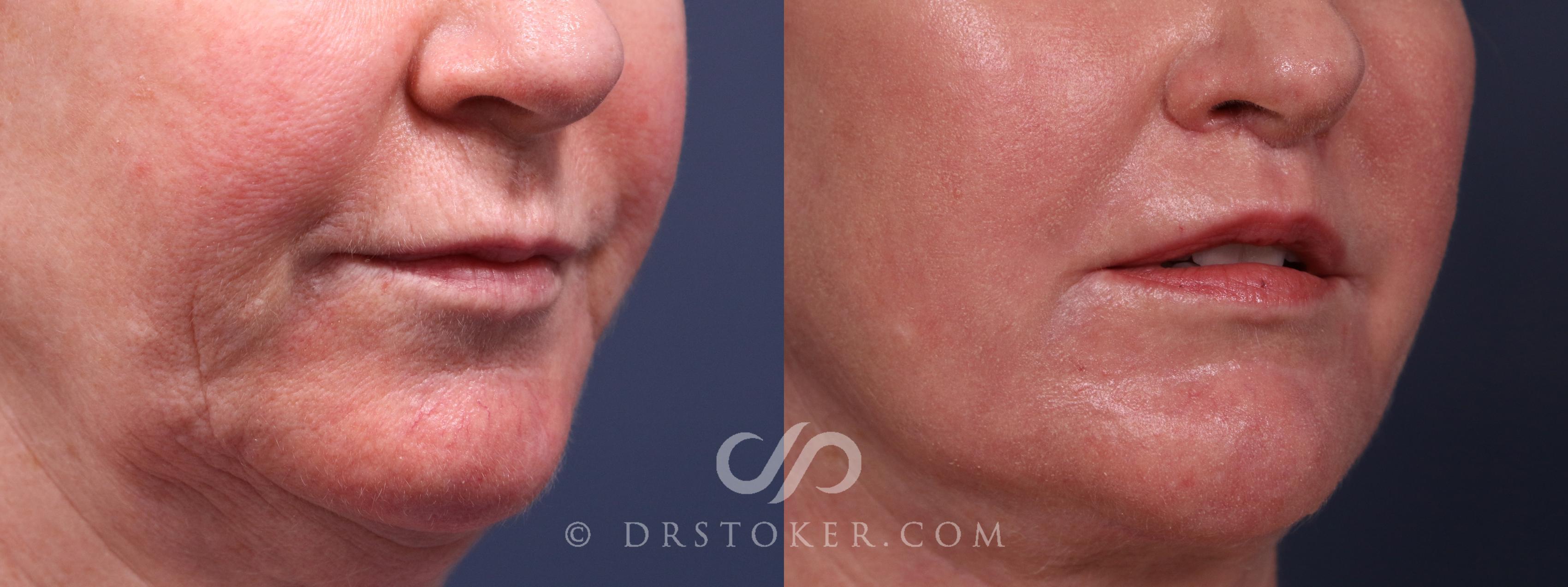 Before & After Lip Lift Case 2342 Right Oblique View in Los Angeles, CA