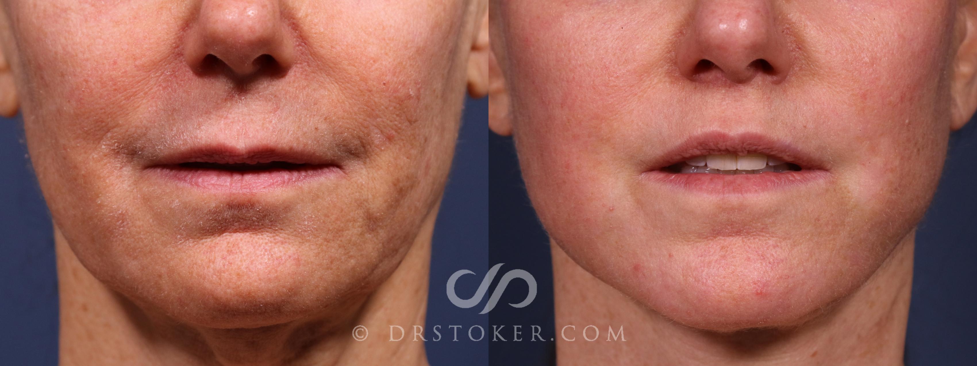 Before & After Lip Lift Case 2378 Front View in Los Angeles, CA