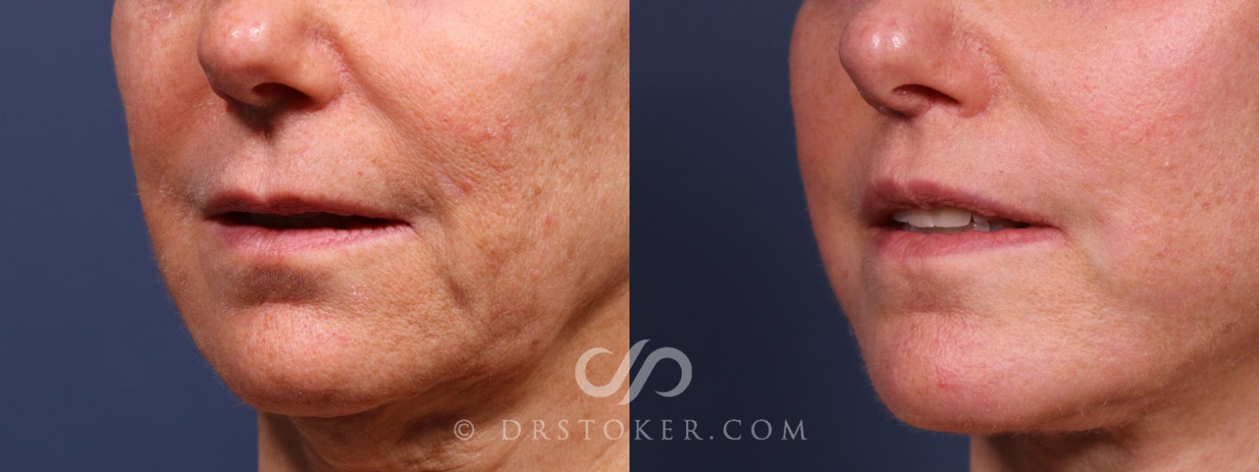 Before & After Lip Lift Case 2378 Left Oblique View in Los Angeles, CA