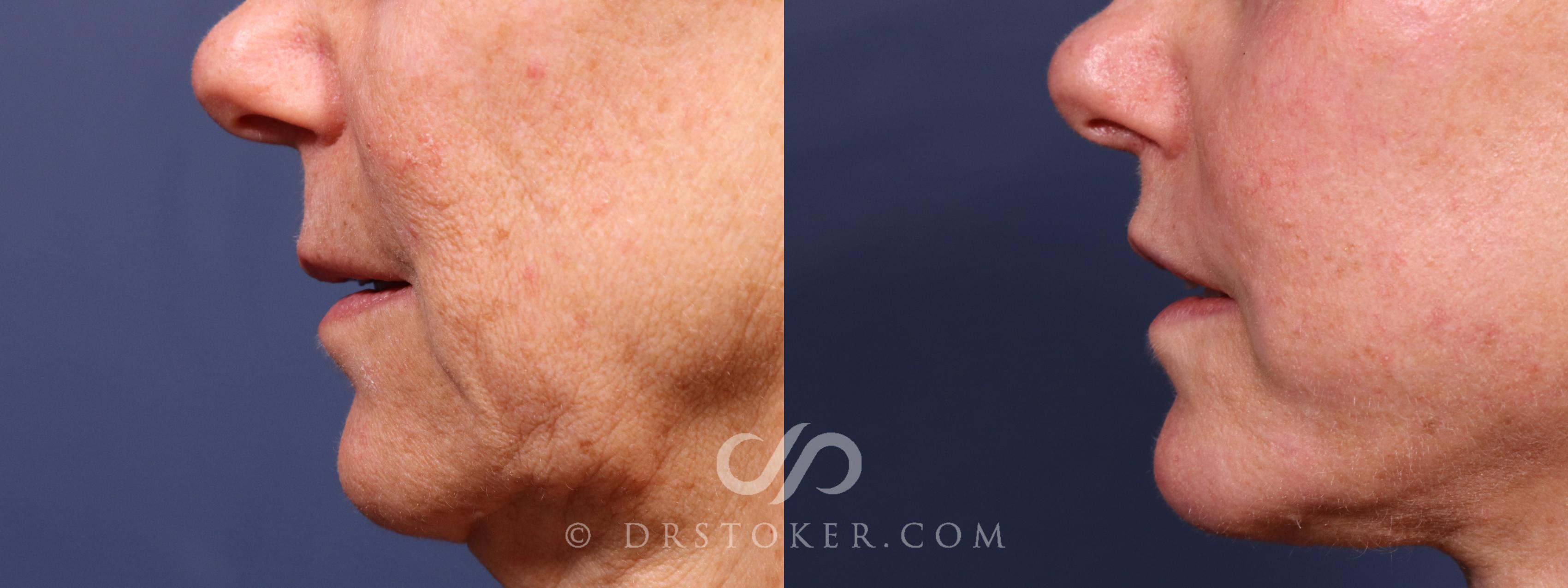 Before & After Lip Lift Case 2378 Left Side View in Los Angeles, CA