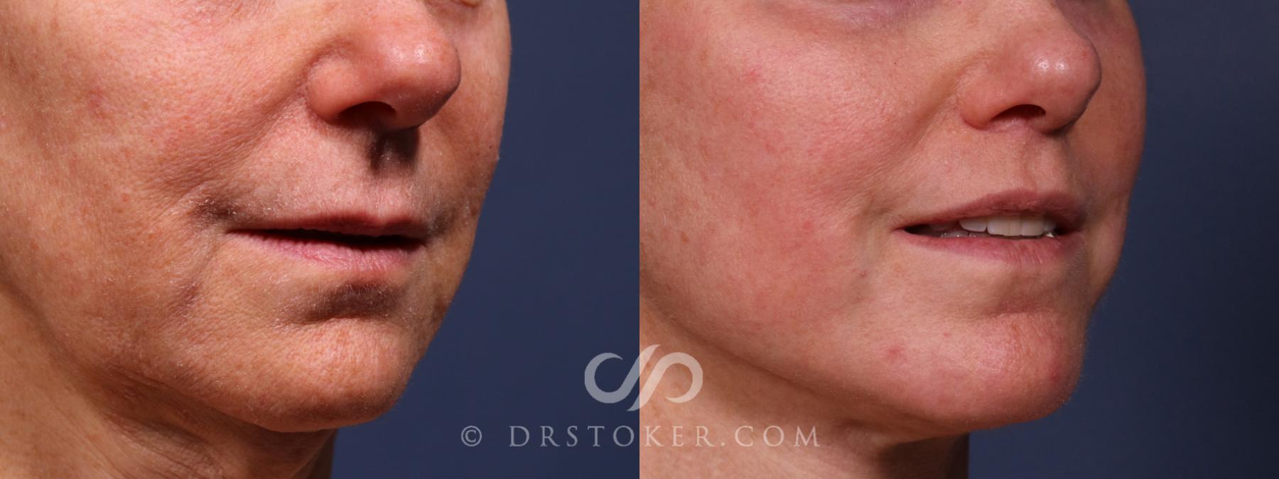 Before & After Lip Lift Case 2378 Right Oblique View in Los Angeles, CA