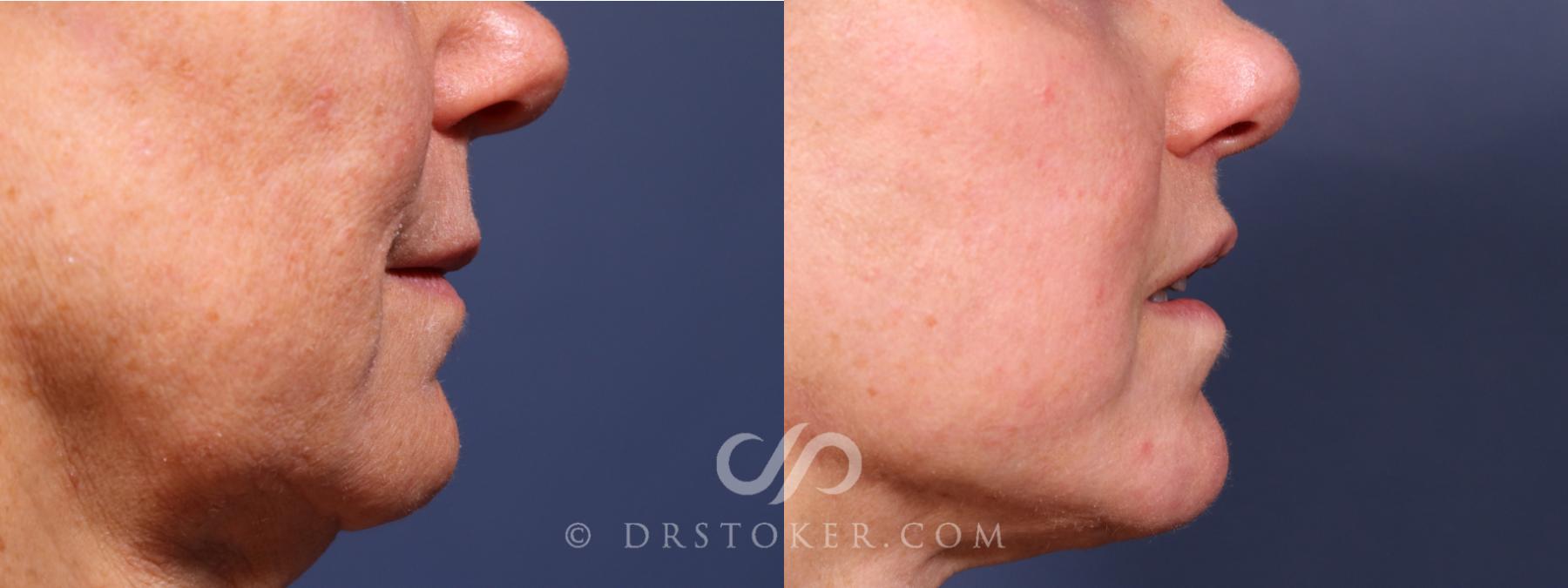 Before & After Lip Lift Case 2378 Right Side View in Los Angeles, CA