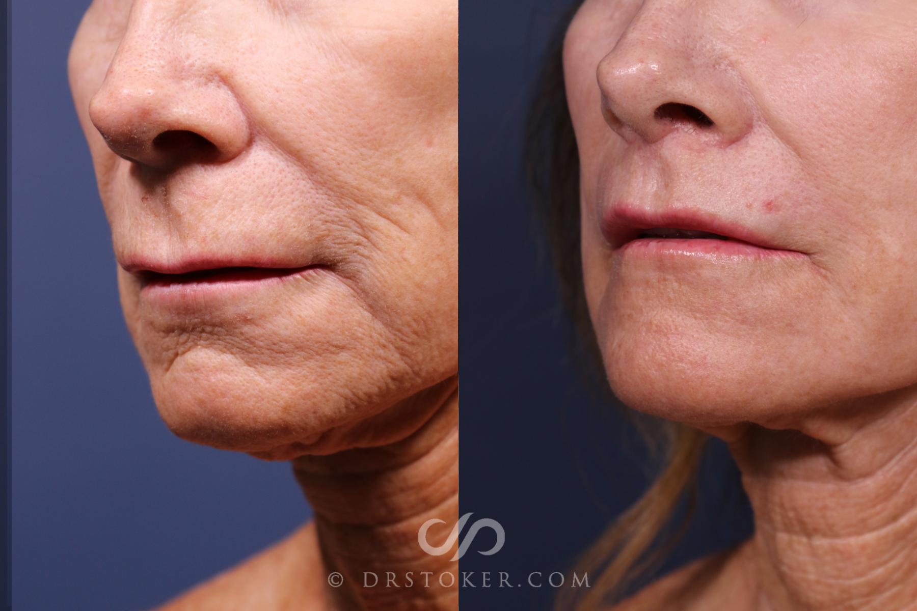 Before & After Lip Lift Case 2578 Left Oblique View in Los Angeles, CA