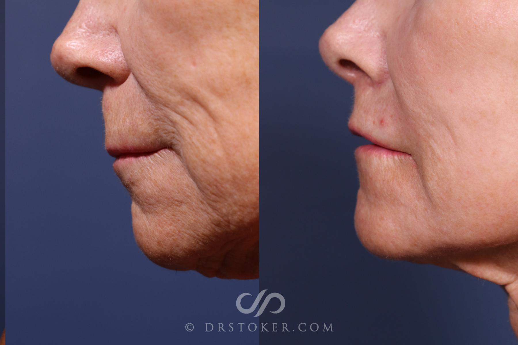 Before & After Lip Lift Case 2578 Left Side View in Los Angeles, CA