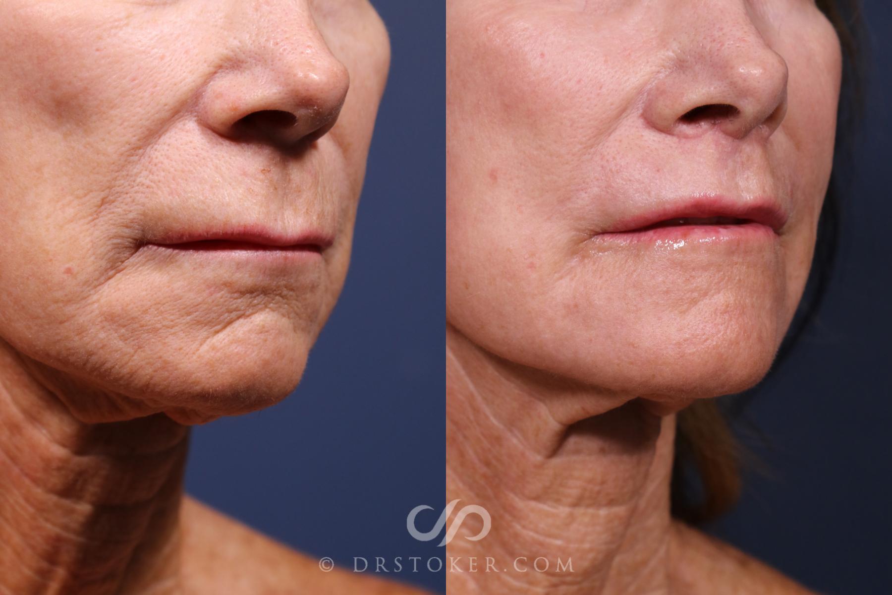 Before & After Lip Lift Case 2578 Right Oblique View in Los Angeles, CA