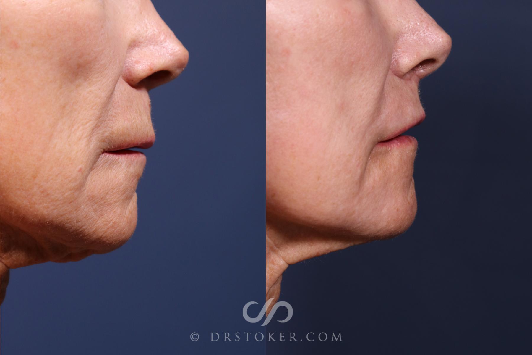 Before & After Lip Lift Case 2578 Right Side View in Los Angeles, CA